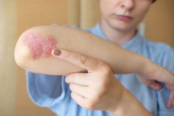Is there any cure for psoriasis in Ayurveda?