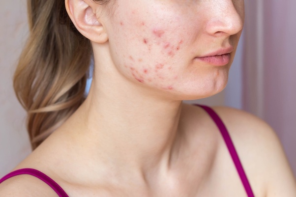 Which is the best anti acne cream available in India?