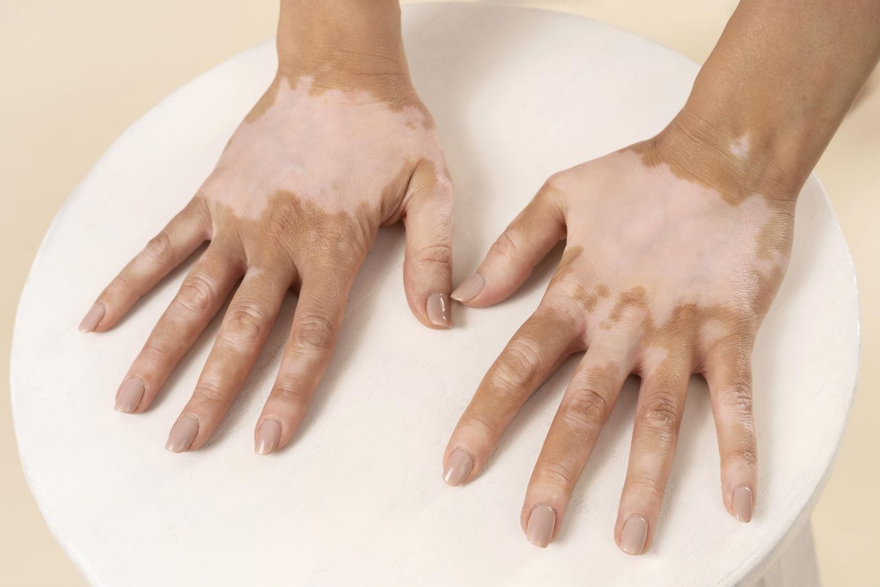 Healing from Within: Ayurvedic Approaches to Treating Vitiligo