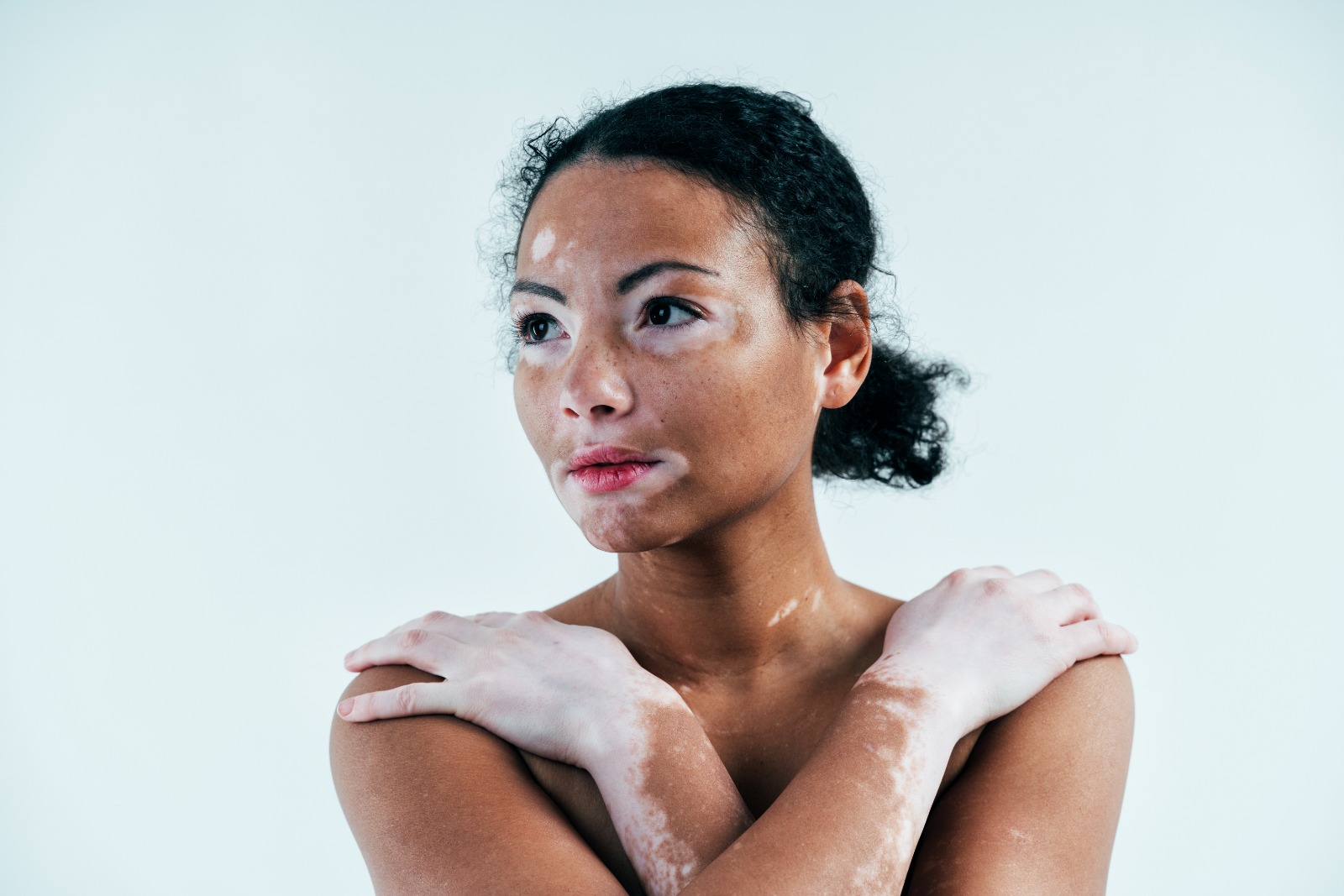 Which medicine is helpful for vitiligo?