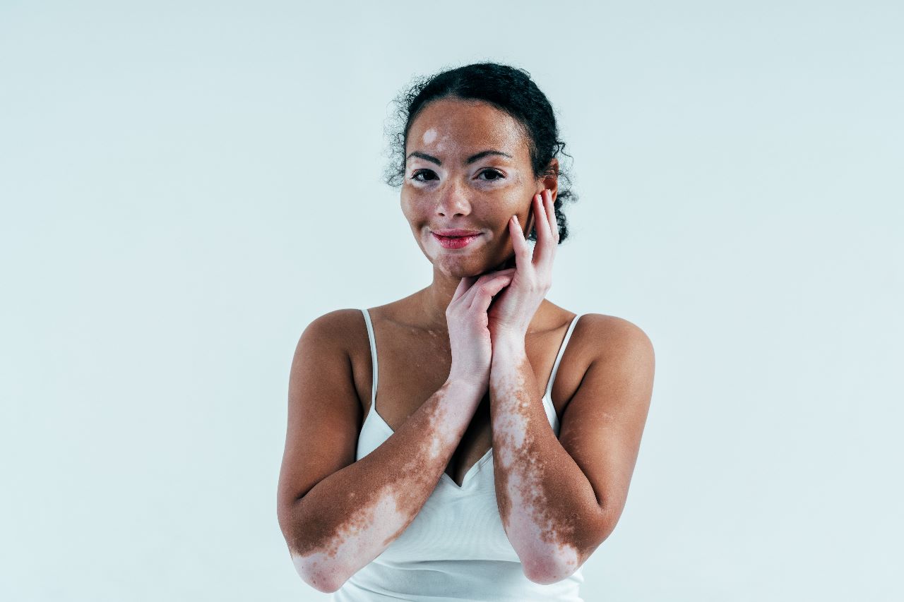 Say Goodbye to Vitiligo: 6 Natural Remedies You Need to Try Today
