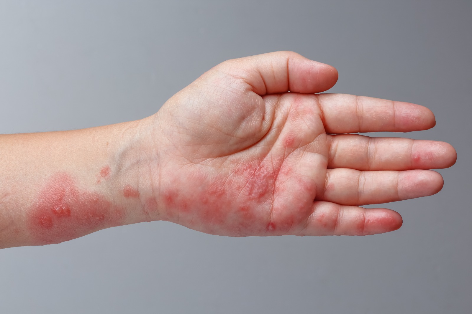 What is the best way to get rid of skin allergy?