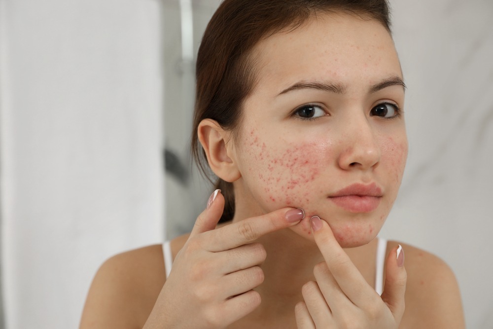 Do blood purifiers (drug/tonic) really help to cure acne problem?