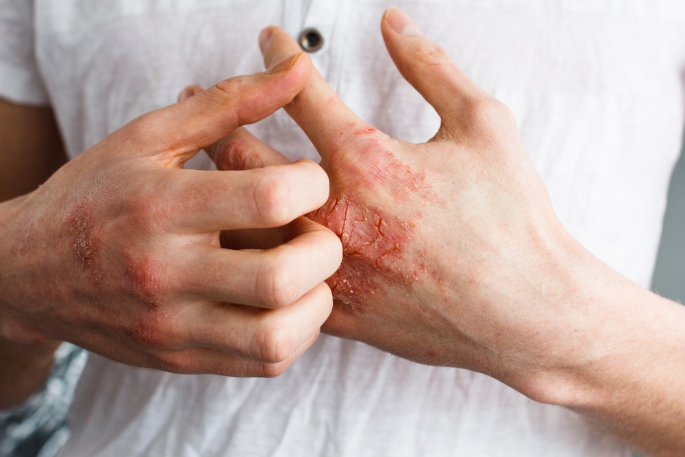 Is Ayurvedic medicine effective for eczema?