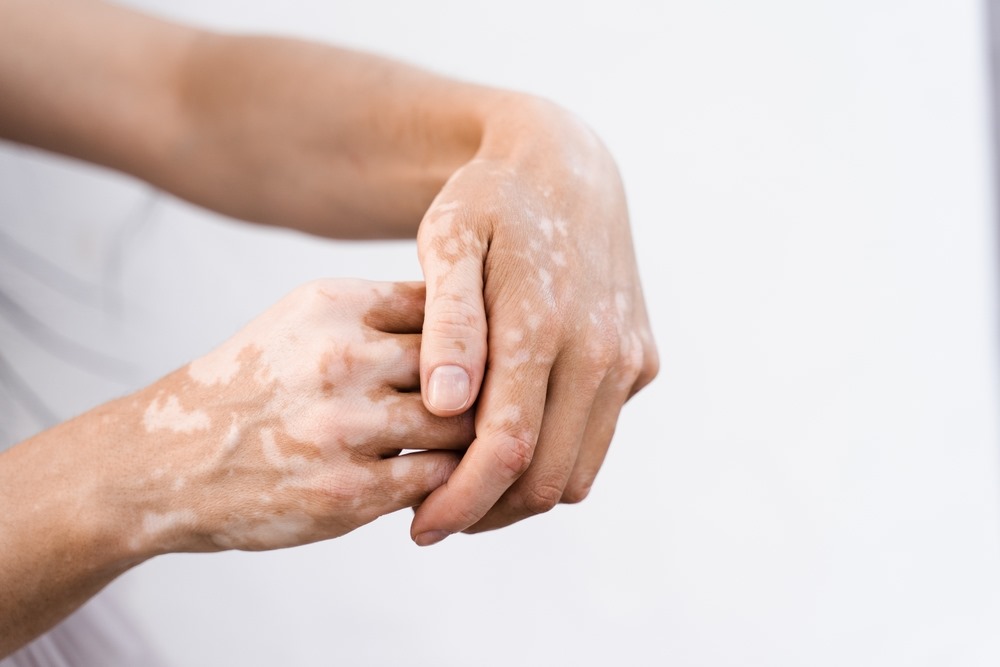   Unlocking Nature's Remedy: How Bakuchi Can Help Treat Vitiligo 