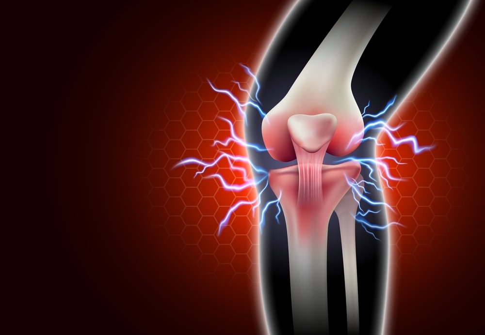 Has anyone had a positive experience using glucosamine to treat knee pain?