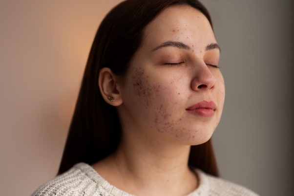 How can I get rid of dark spots?